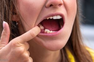 dente mancante