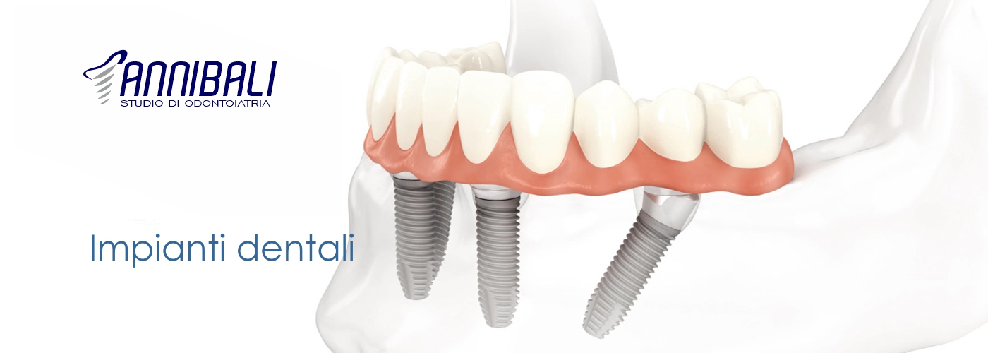 impianti dentali a Roma Prati