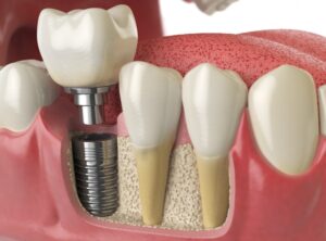 impianti dentali a Roma Prati anatomia denti sani