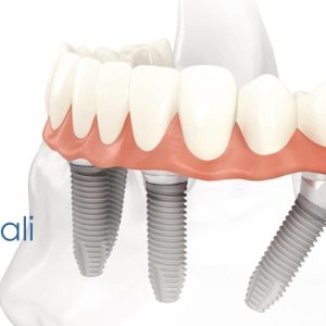 impianti dentali a Roma Prati