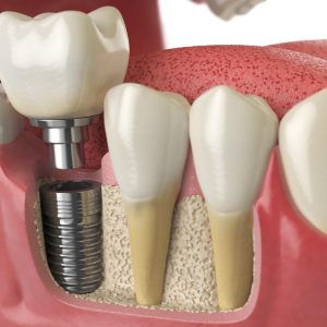 impianti dentali a Roma Prati anatomia denti sani
