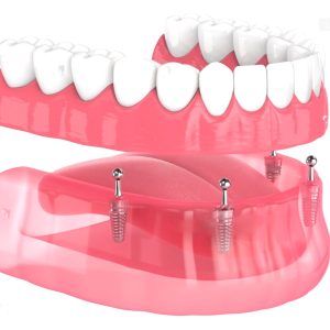 implantologia transmucosa all on 4 a Roma